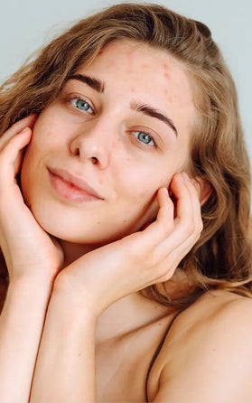 Dit is waarom skincare helpt bij het bestrijden van Acne