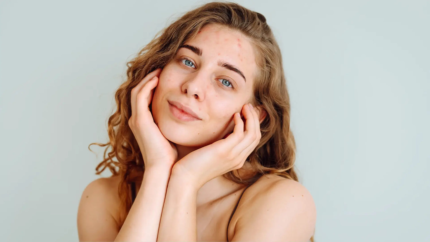 Waarom helpt skincare bij acne en puistjes bestrijden