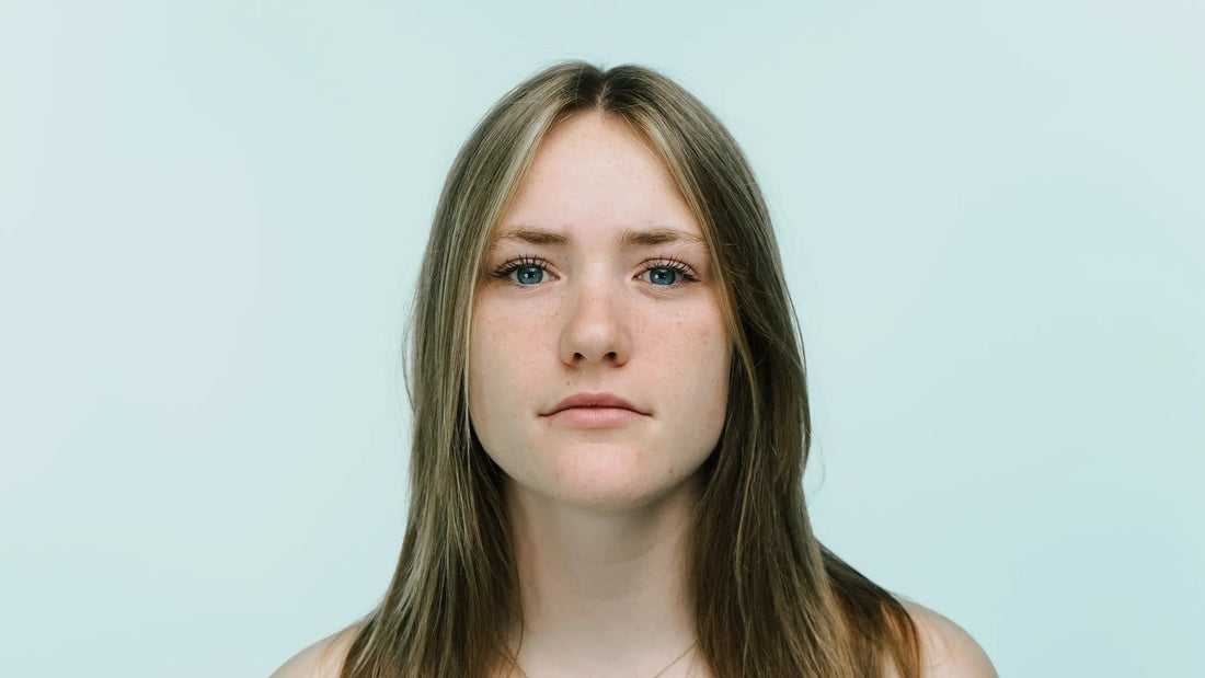 Jonge vrouw met een paar puistjes op kin en voorhoofd, hormonale acne na het stoppen met de pil