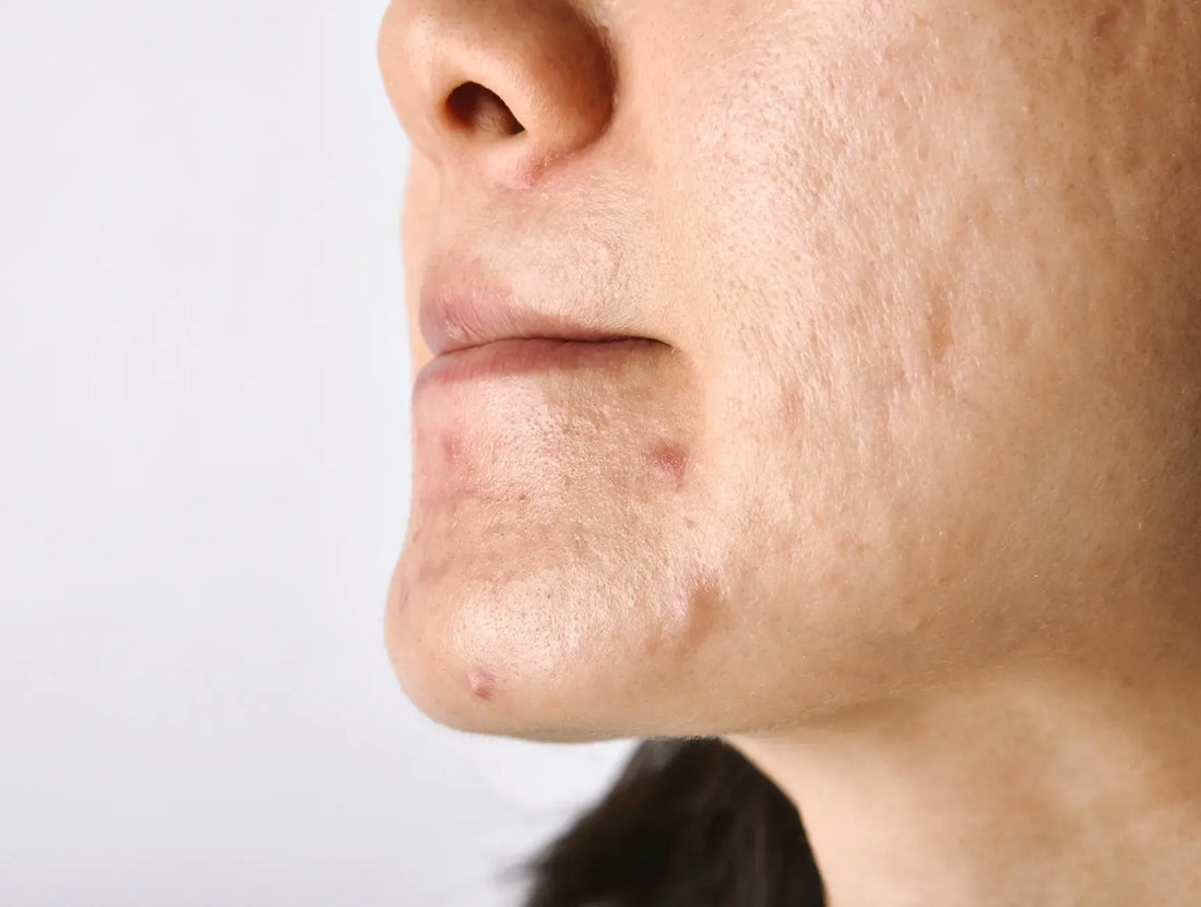 Huidtype: Vette Huid | Informatie Blog