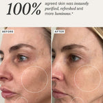 ALPHA-H Illuminating Enzyme Polis Before After