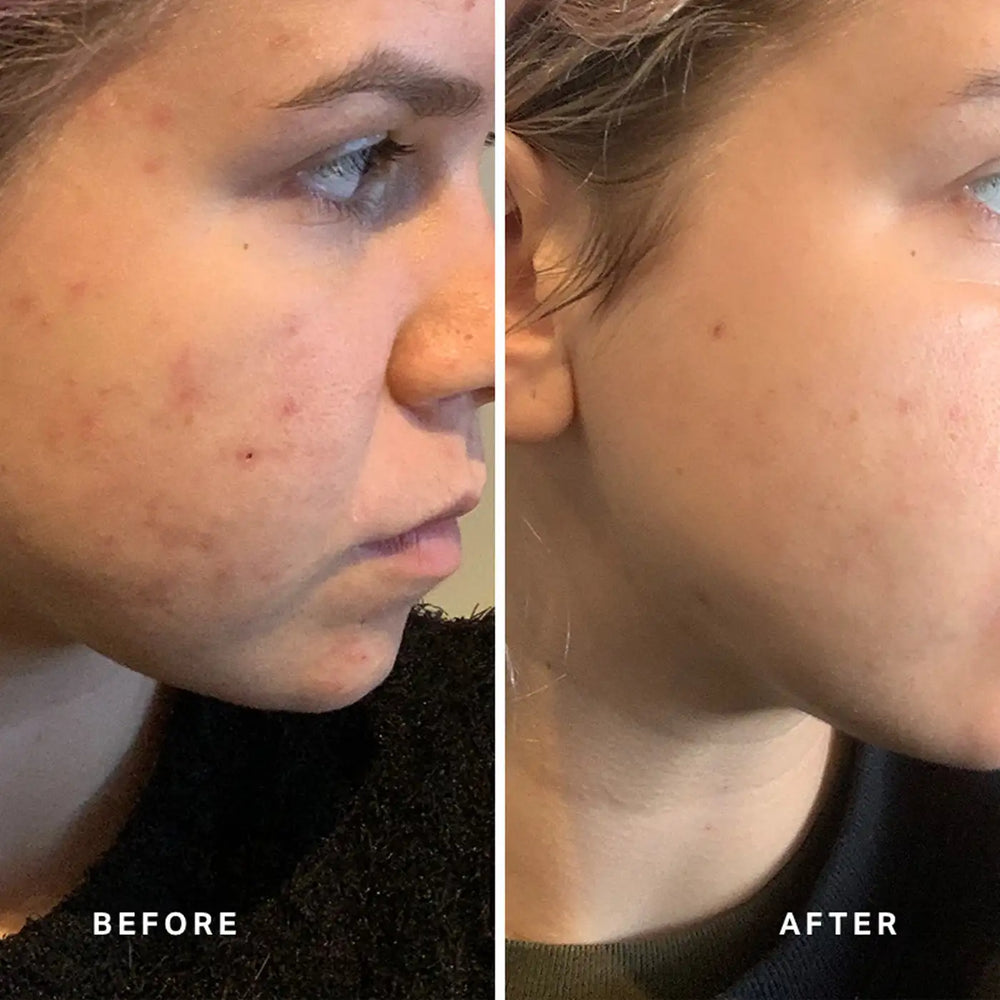 Alpha H Instant Action Bha Blemish Treatment Before After