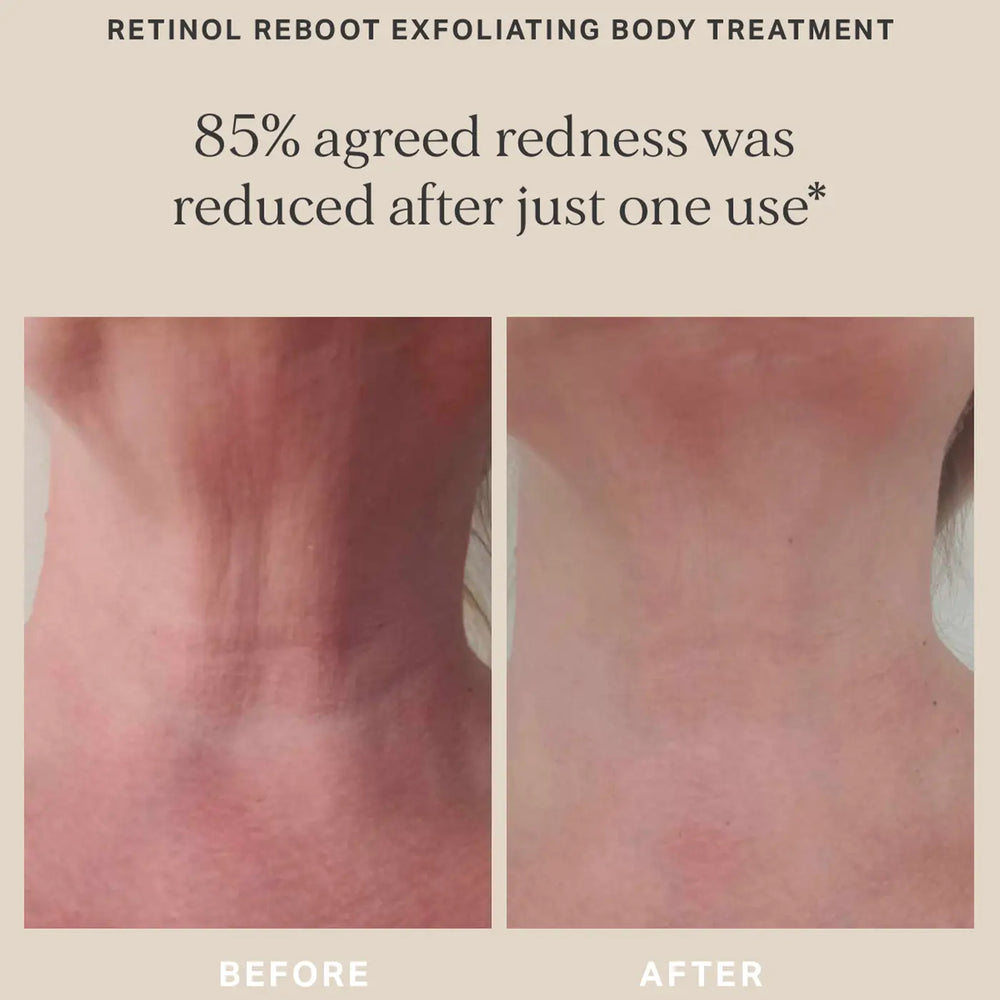 Alpha H Retino Reboot Exfoliating Body Treatment Before After 2