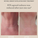 Alpha H Retino Reboot Exfoliating Body Treatment Before After 2