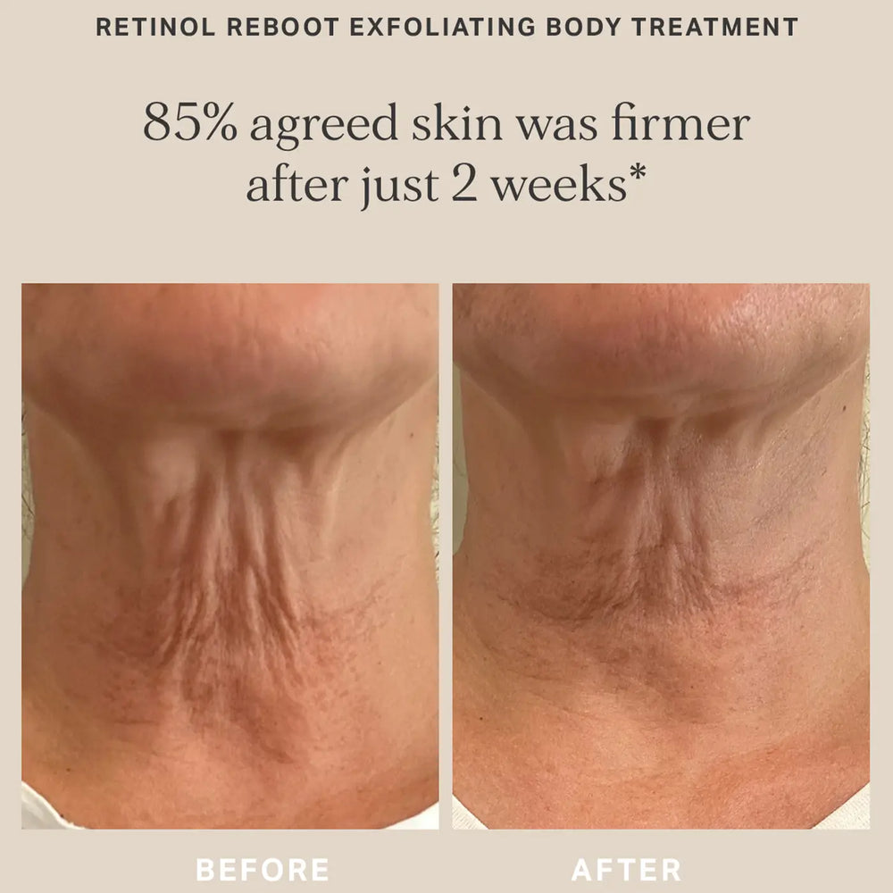 Alpha H Retino Reboot Exfoliating Body Treatment Before After
