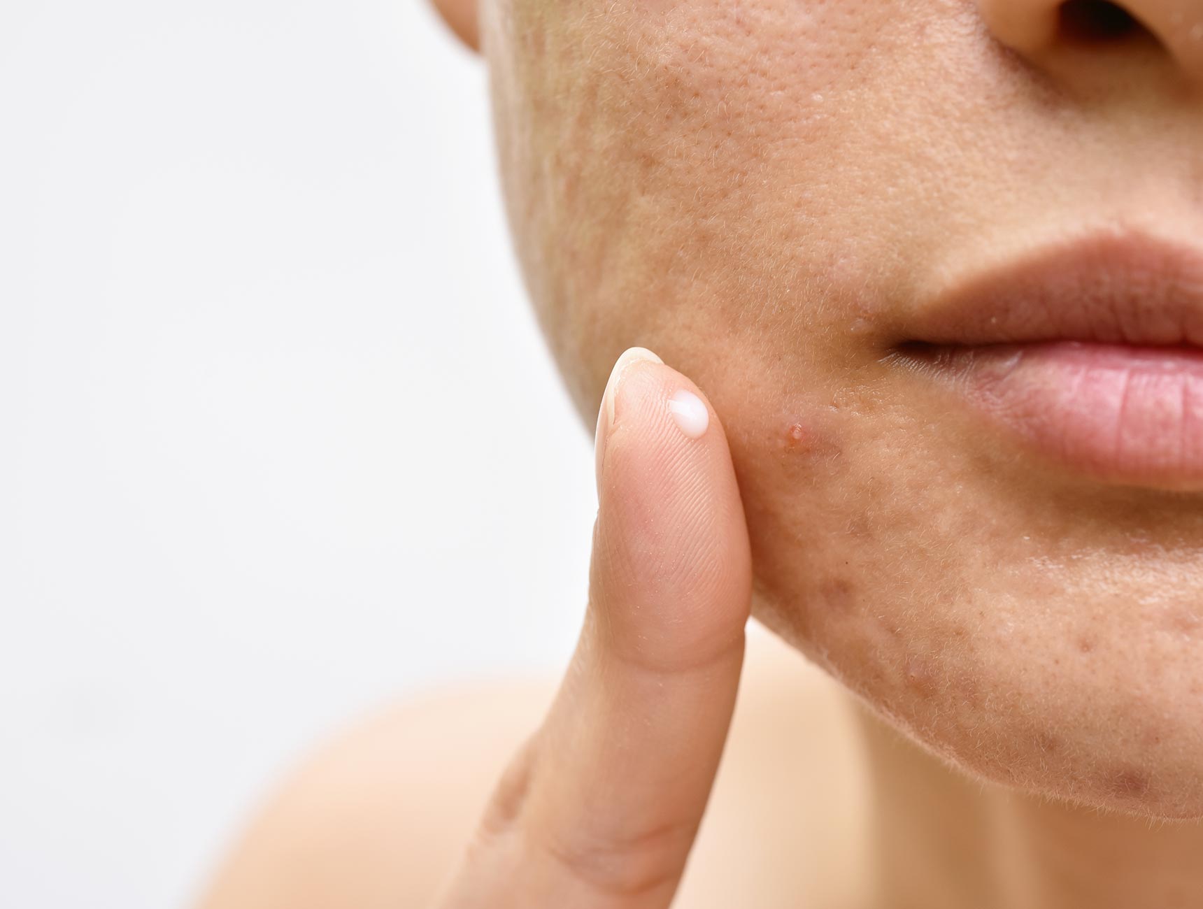 creme acne hormonen