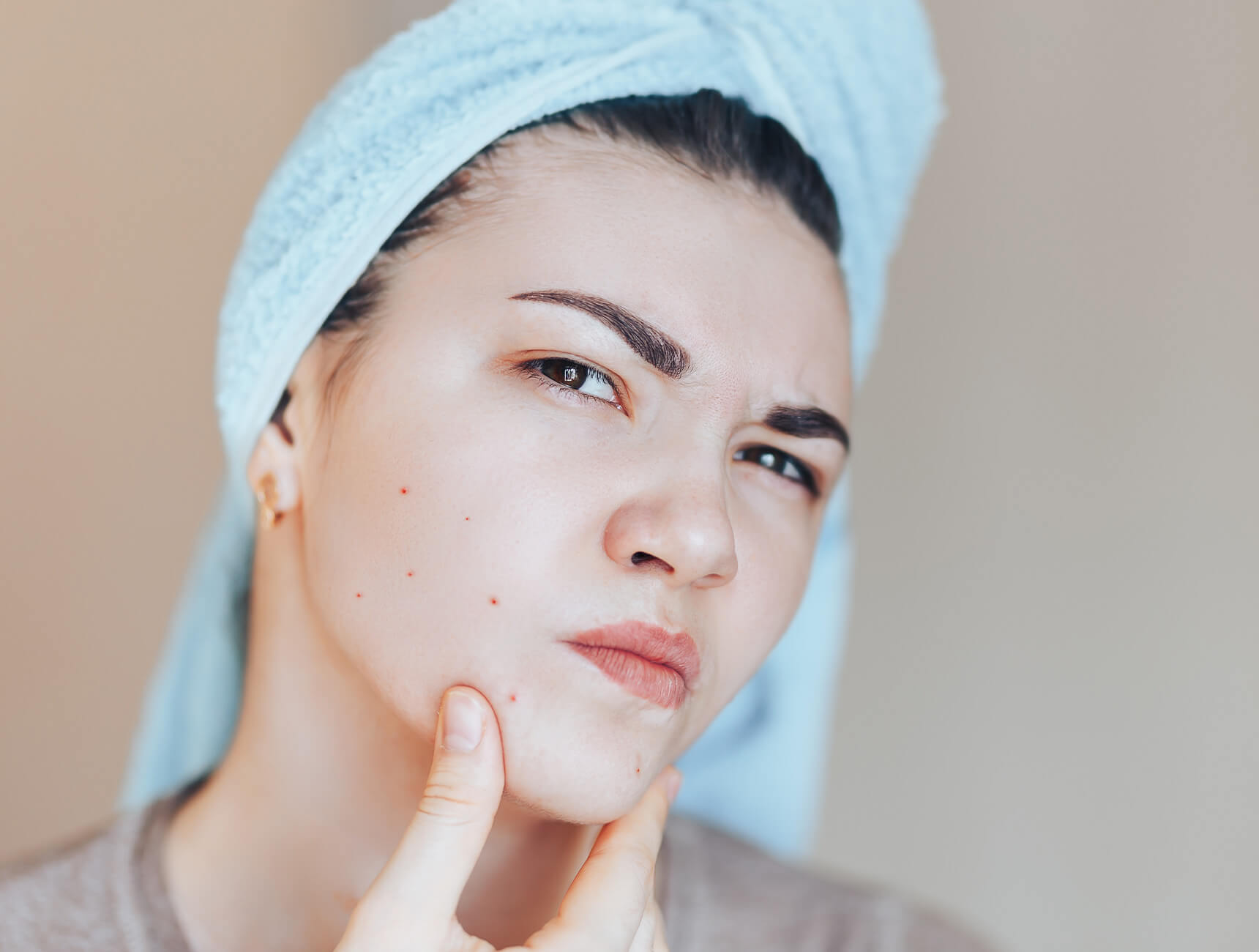 acne benzoylperoxide en saliclyzuur